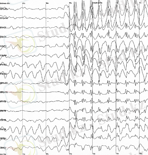 https://upload.wikimedia.org/wikipedia/commons/2/26/Spike-waves.png