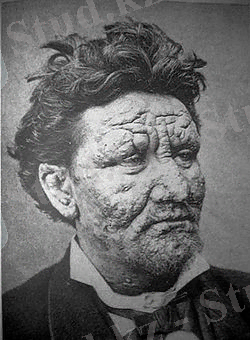 250px-Leprosy