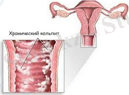 кольпит.jpg