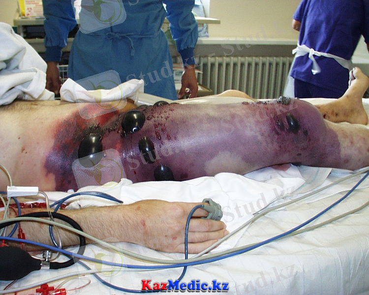 C:\Users\Samsung\Pictures\gazdy-gangrena.jpg