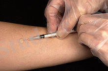 C:\Documents and Settings\user\Мои документы\220px-Mantoux_tuberculin_skin_test.jpg