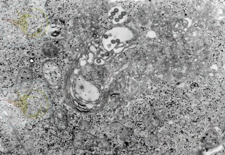 http://static.wikidoc.org/1/16/Rift_Valley_fever_tissue.jpg