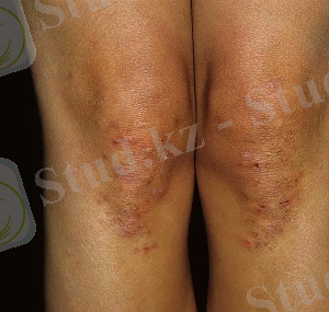 C:\Users\Aliya\Desktop\gerpetiformnyj-dermatit-Djuring-foto-01-300x285.jpg