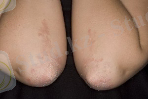 C:\Users\Aliya\Desktop\gerpetiformnyj-dermatit-Djuringa-foto-04-300x200.jpg
