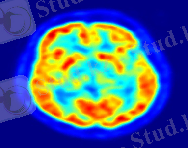 http://upload.wikimedia.org/wikipedia/commons/thumb/c/c6/PET-image.jpg/800px-PET-image.jpg