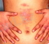 dermatit