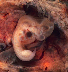 https://upload.wikimedia.org/wikipedia/commons/thumb/2/21/Tubal_Pregnancy_with_embryo.jpg/220px-Tubal_Pregnancy_with_embryo.jpg