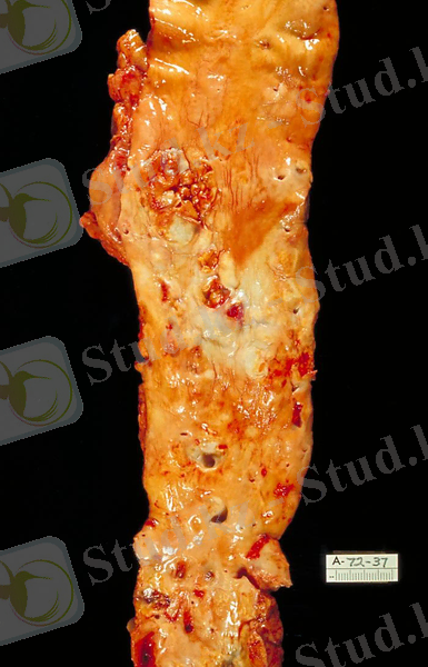 C:\Users\Асия\Desktop\Atherosclerosis,_aorta,_gross_pathology_PHIL_846_lores.jpg