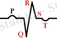 C:\Users\007\Desktop\экг\Healing_myocardial_infarction.jpg