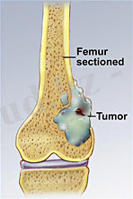 chondrosarcoma-861.jpg
