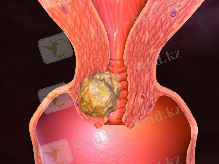 rabdomioma.jpg