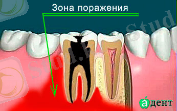 http://www.adent.ru/images/osteomielit-cheljusti3.jpg