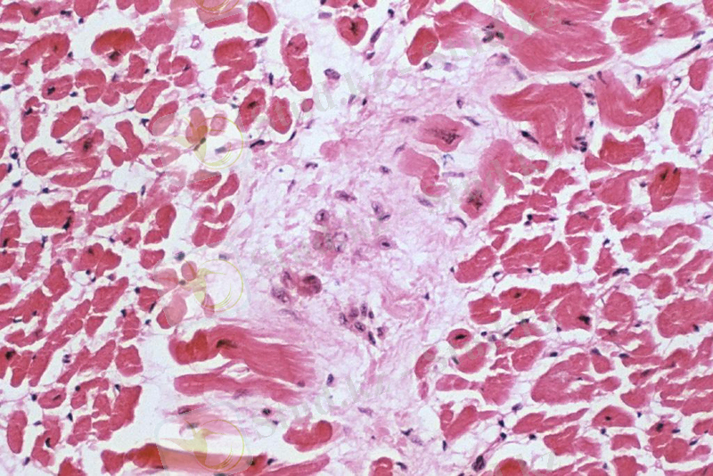 C:\Users\Sayat\Desktop\aschoff_body_in_rheumatic_myocarditis1337901201041.jpg
