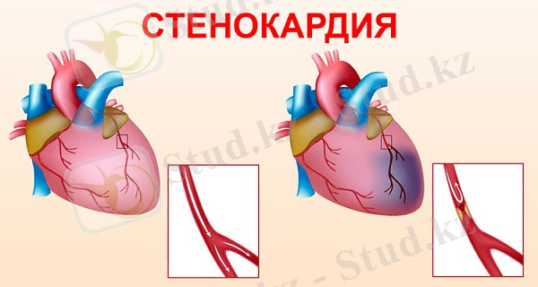 C:\Users\ASUS\Desktop\Stenoc.jpg
